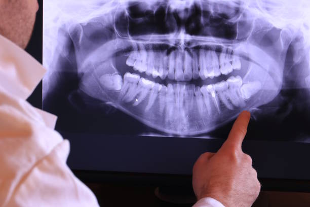 Best Emergency Root Canal Treatment in Union Hall, VA